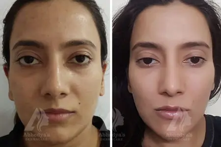 Before & After Result of Treatment