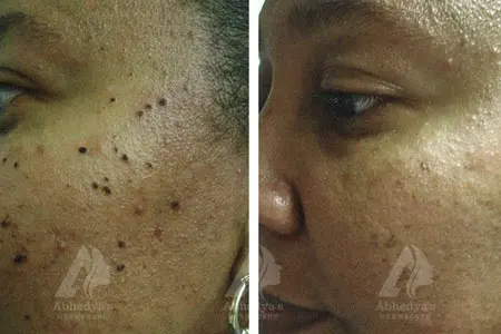 Before & After Result of Treatment