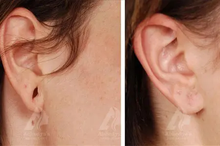 Before & After Result of Treatment