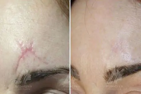 Before & After Result of Treatment