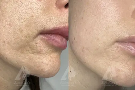 Before & After Result of Treatment