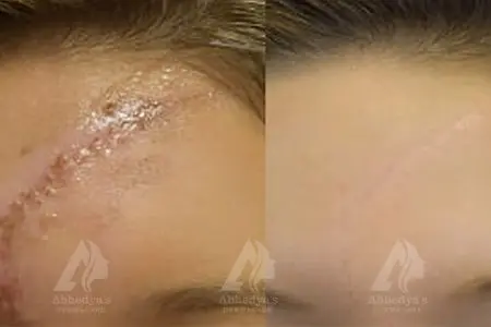 Before & After Result of Treatment