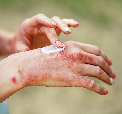 Atopic dermatitis