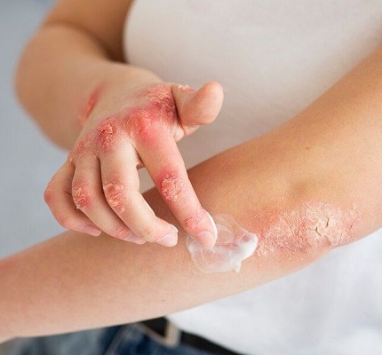 Eczema