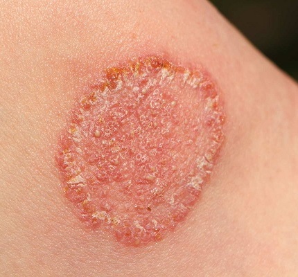 Dermatophytose sur le genou