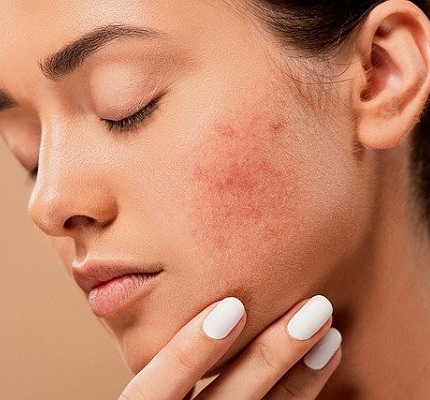 Pimples