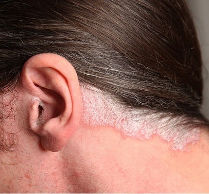 Psoriasis